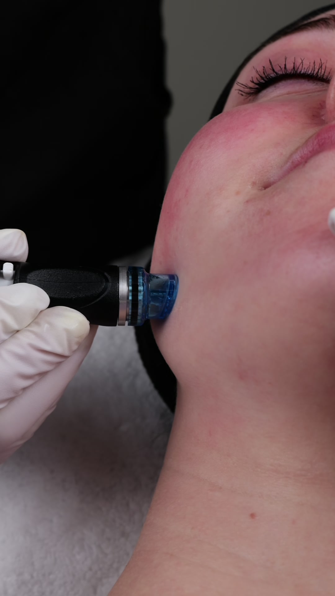 HydraFacial resultat 2 Avisen Beauty