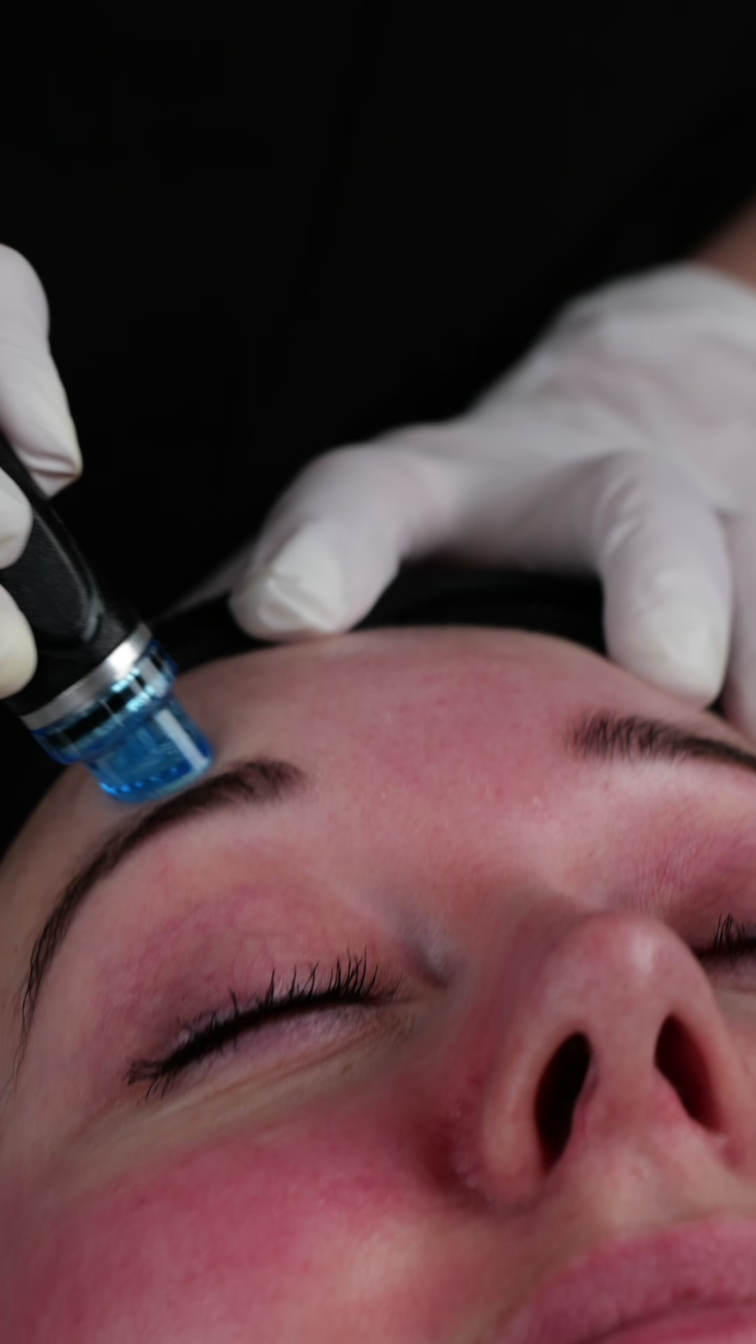 HydraFacial resultat 3 Avisen Beauty